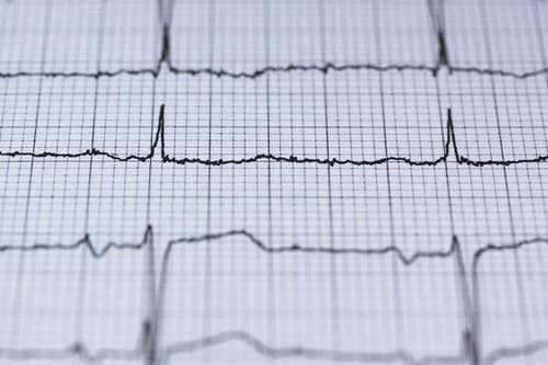 ECG Monitoring for Mental Health Service Users